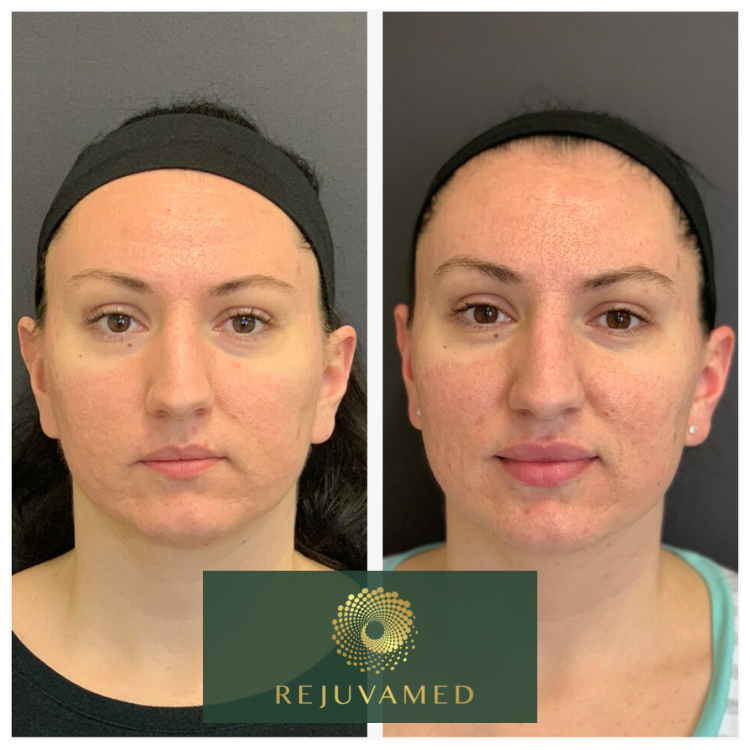 Before and after image of Botox treatment for a Lip Flip