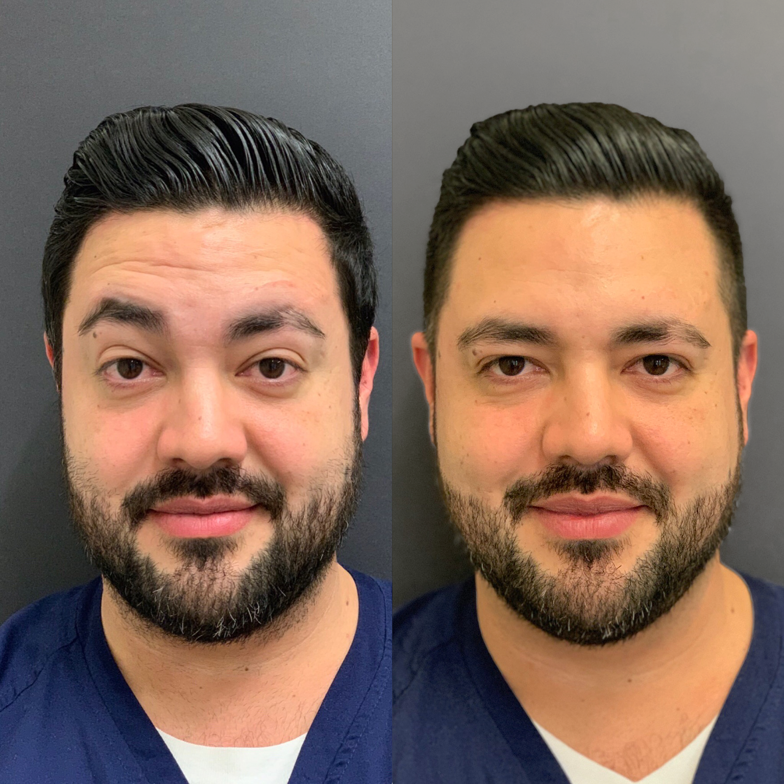 Before and After Botox