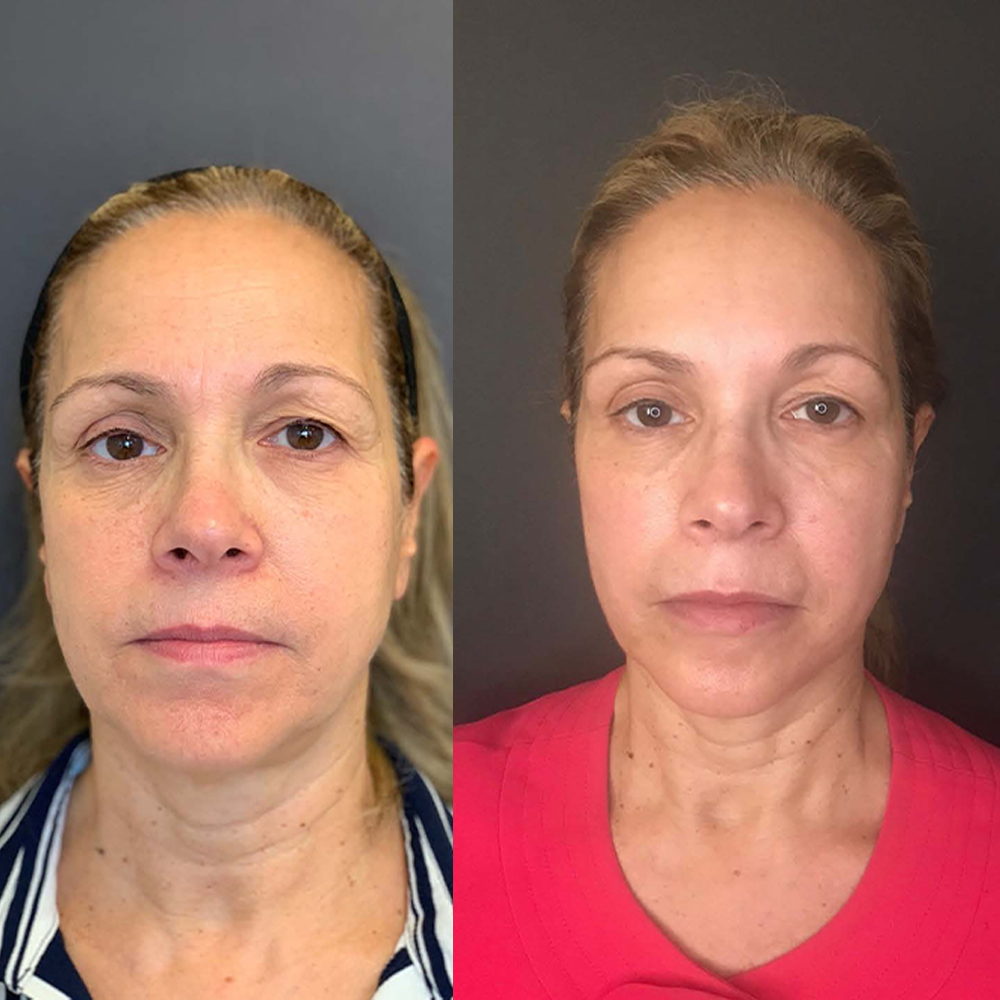 Image showing before and after result of 3 Picosure Laser treatments and 50 units of Botox.