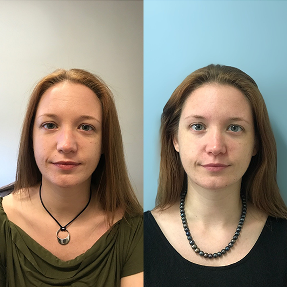 Image showing before and after results of 50 units of Botox to smooth lines and wrinkles.