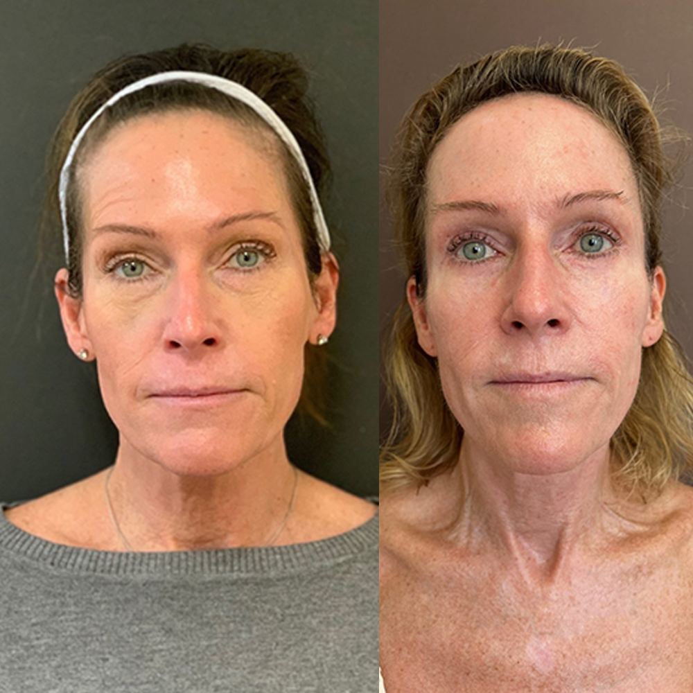 Image showing Results Before and After 3 sessions of Microneedling with PRP