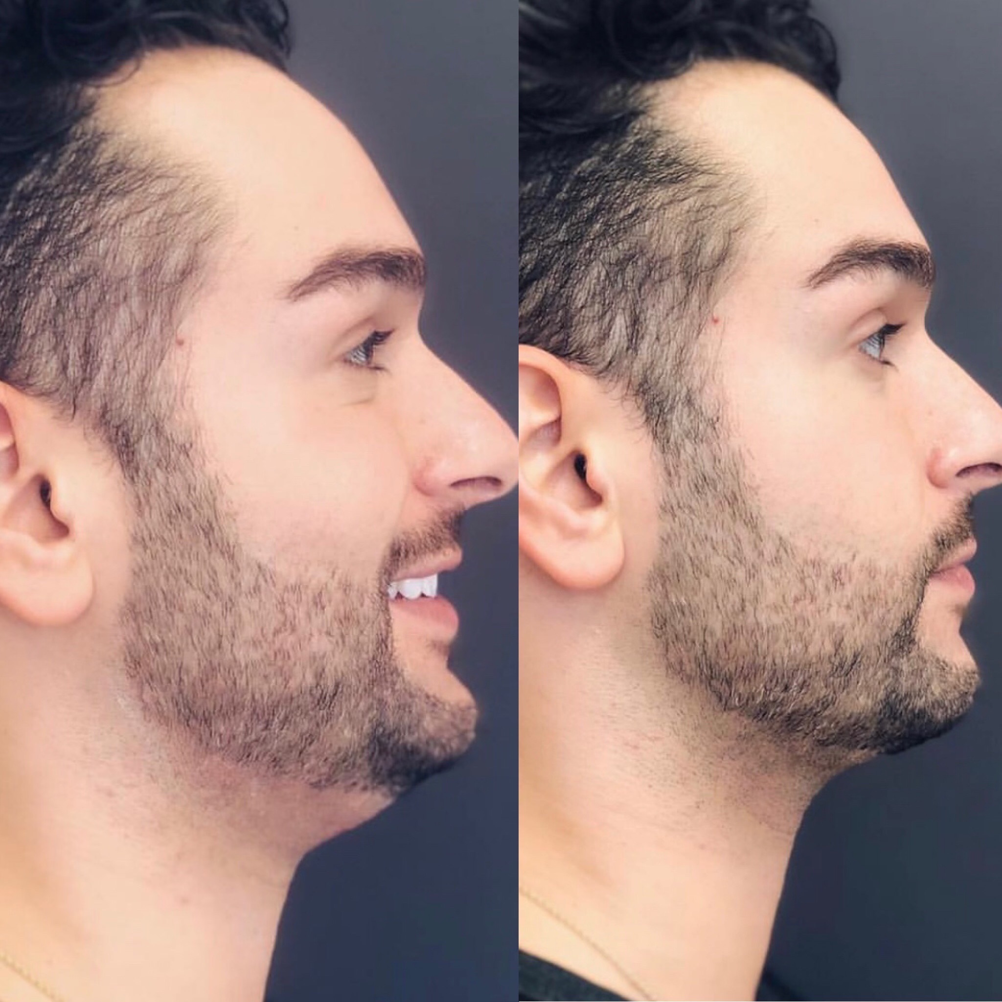 Image showing results before and after 3 vials of Kybella to reduce submental fat.