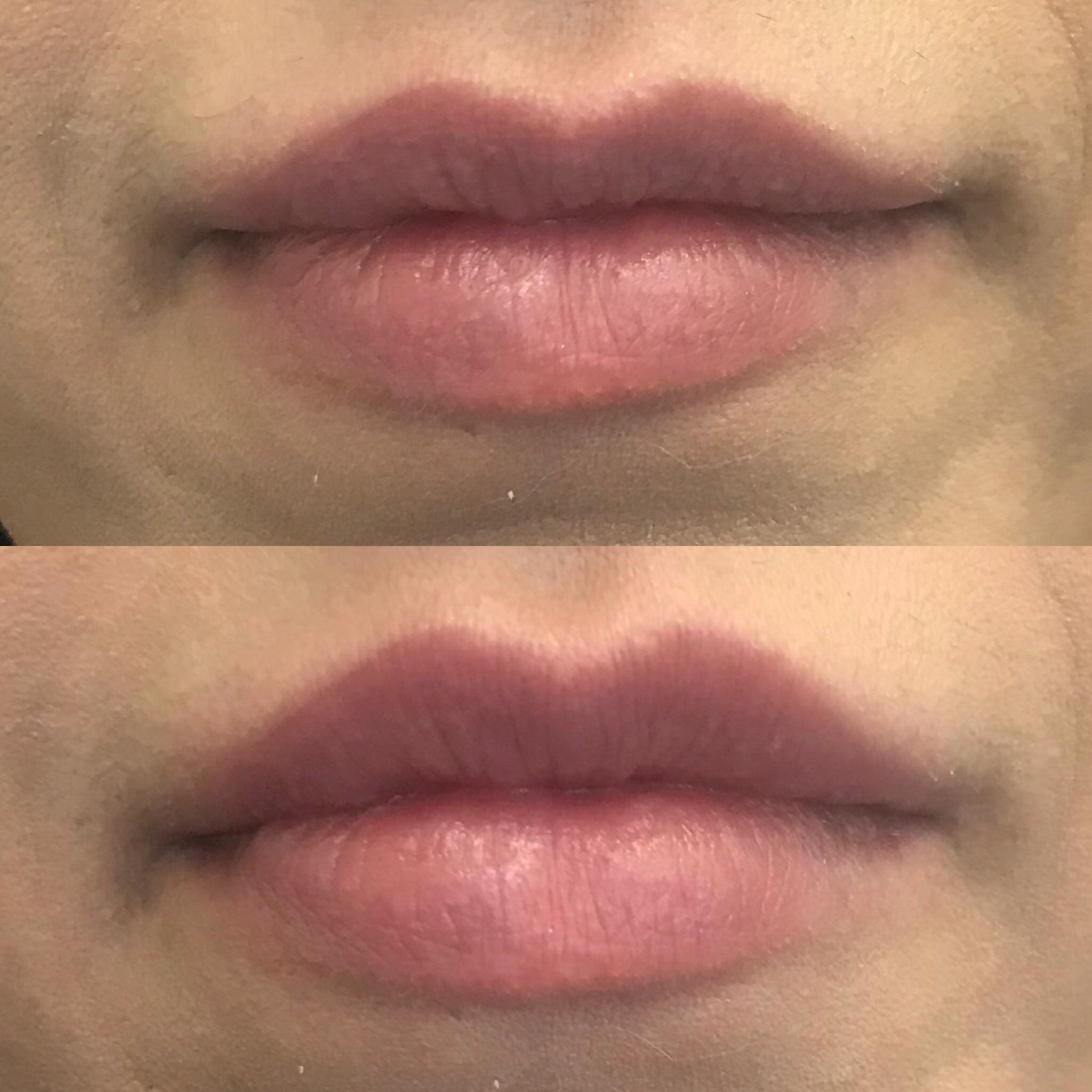 Before and After Results of Lip filler to improve lip fullness.