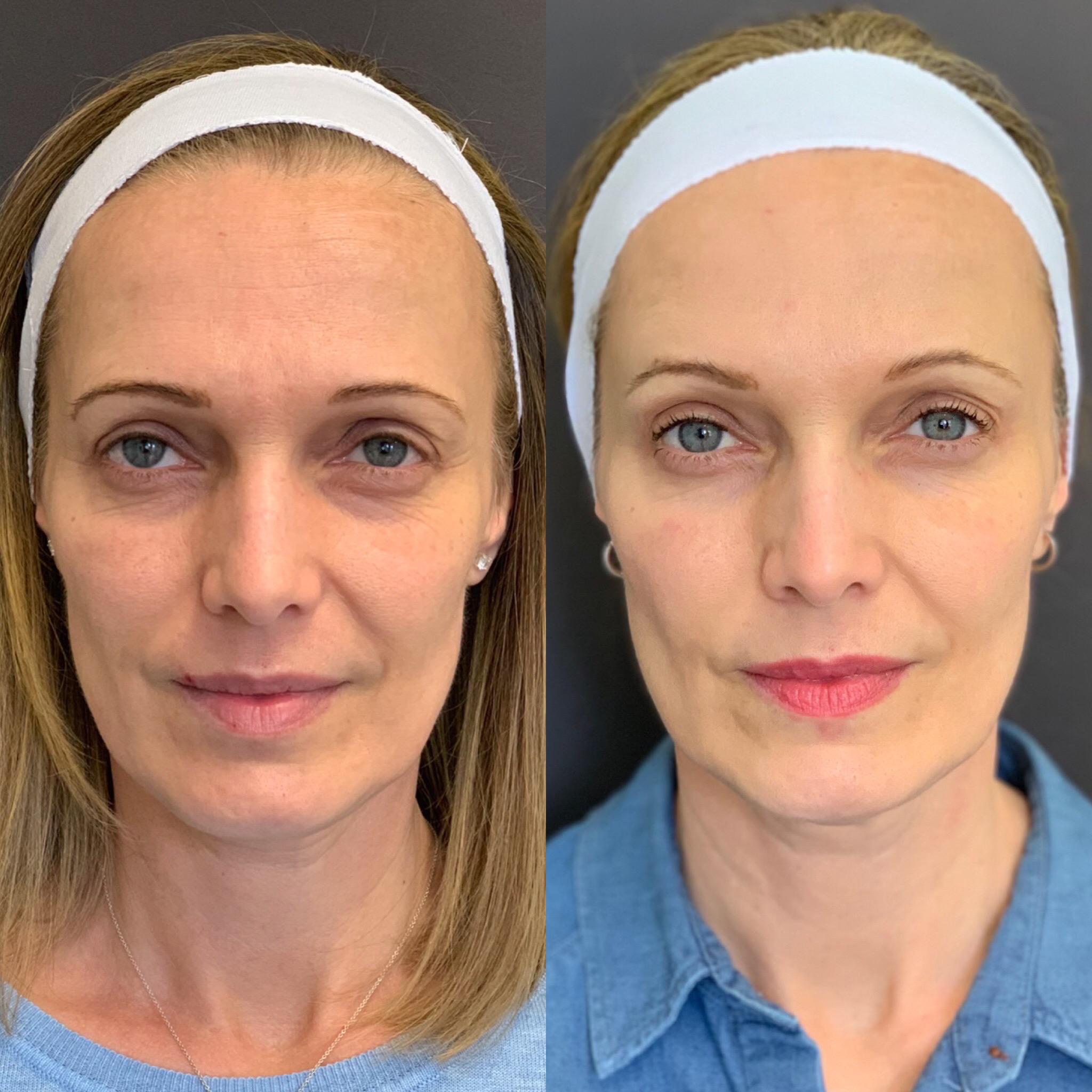 Image showing before and after results of 2 syringes of restylane Lyft for cheek definition and 50 units of Botox.