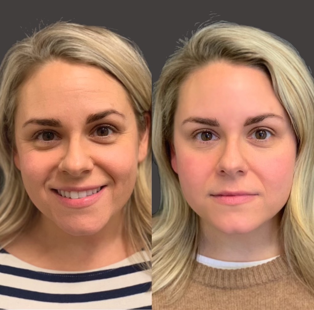 Image showing Results Before and After 50 units of Botox to smooth lines and wrinkles.