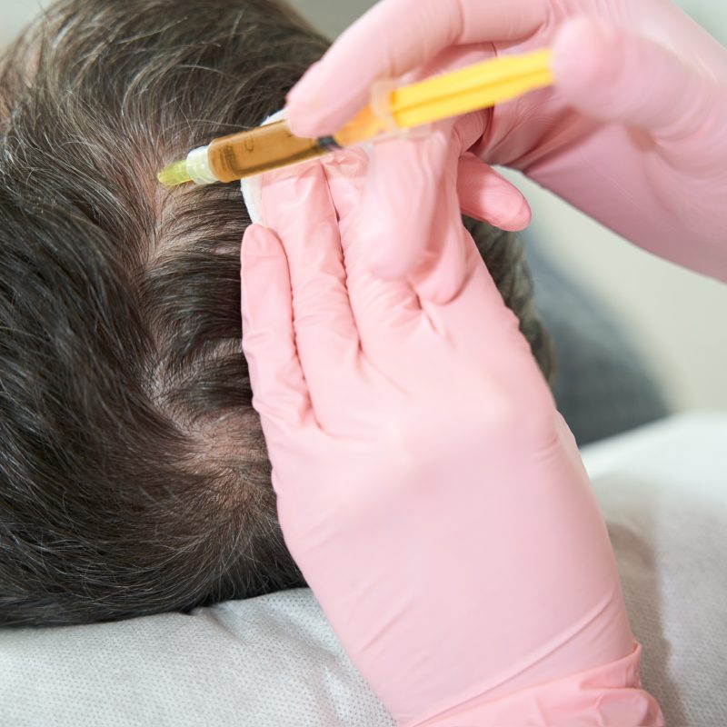 Specialist performs the plasmolifting procedure in the scalp, the doctor works in protective gloves